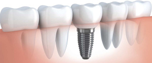 Kaip pasirinkti dantų implantus?