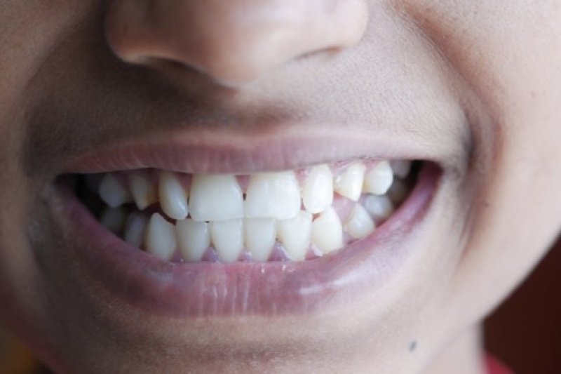 Burnos irigatorius ar elektrinis dantų šepetukas: skirtumas ir pasirinkimas