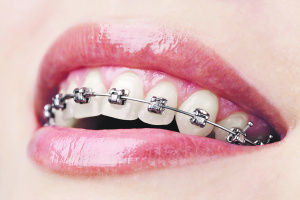 Odontologijos klinikoje „Estetinė odontologija“ pacientams dantys tiesinami ir breketais.