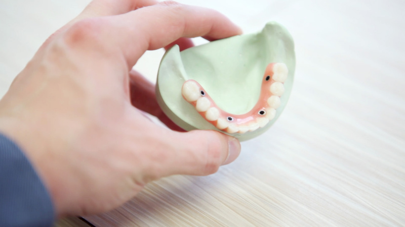 Kodėl verta rinktis dantų implantus?