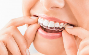 Populiariausi dantų tiesinimo metodai