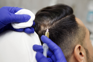 Mezoterapija plaukams: ir sveikatai gerinti, ir grožiui puoselėti