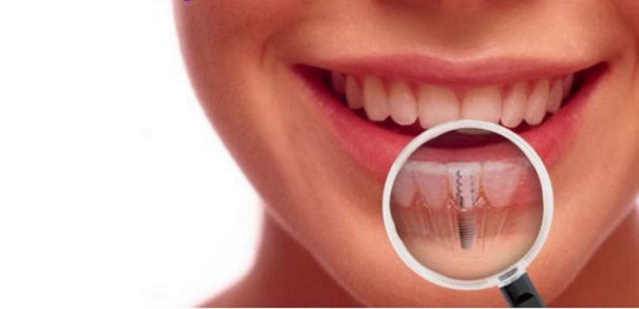Dantų implantavimas – vis labiau populiarėjantis pasirinkimas