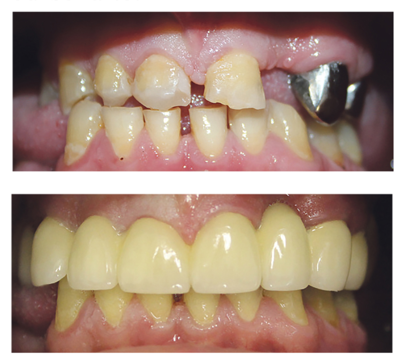 o būtinybė / Šiuo metu odontologijos klinikoje „Estetinė odontologija“ konsultacija dėl dantų implantavimo ir protezavimo NEMOKAMA.